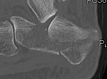 Calcaneal Fracture Lateral CT